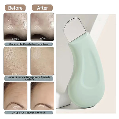 Deep Cleansing Blackhead and Whitehead Removal Tool for Nose and Face - Skin Pore Cleaner Skin Care Beauty Tools Hot Sale